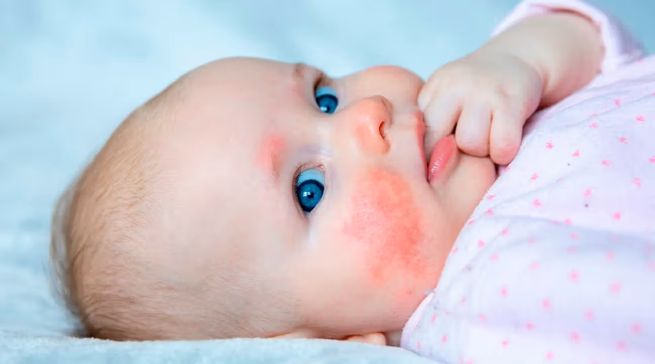 Infant Allergy