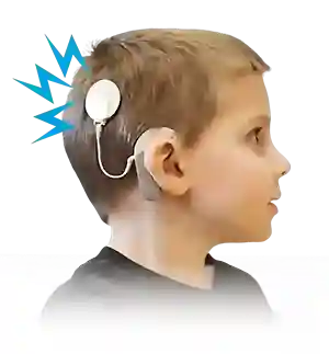 Cochlear Implant